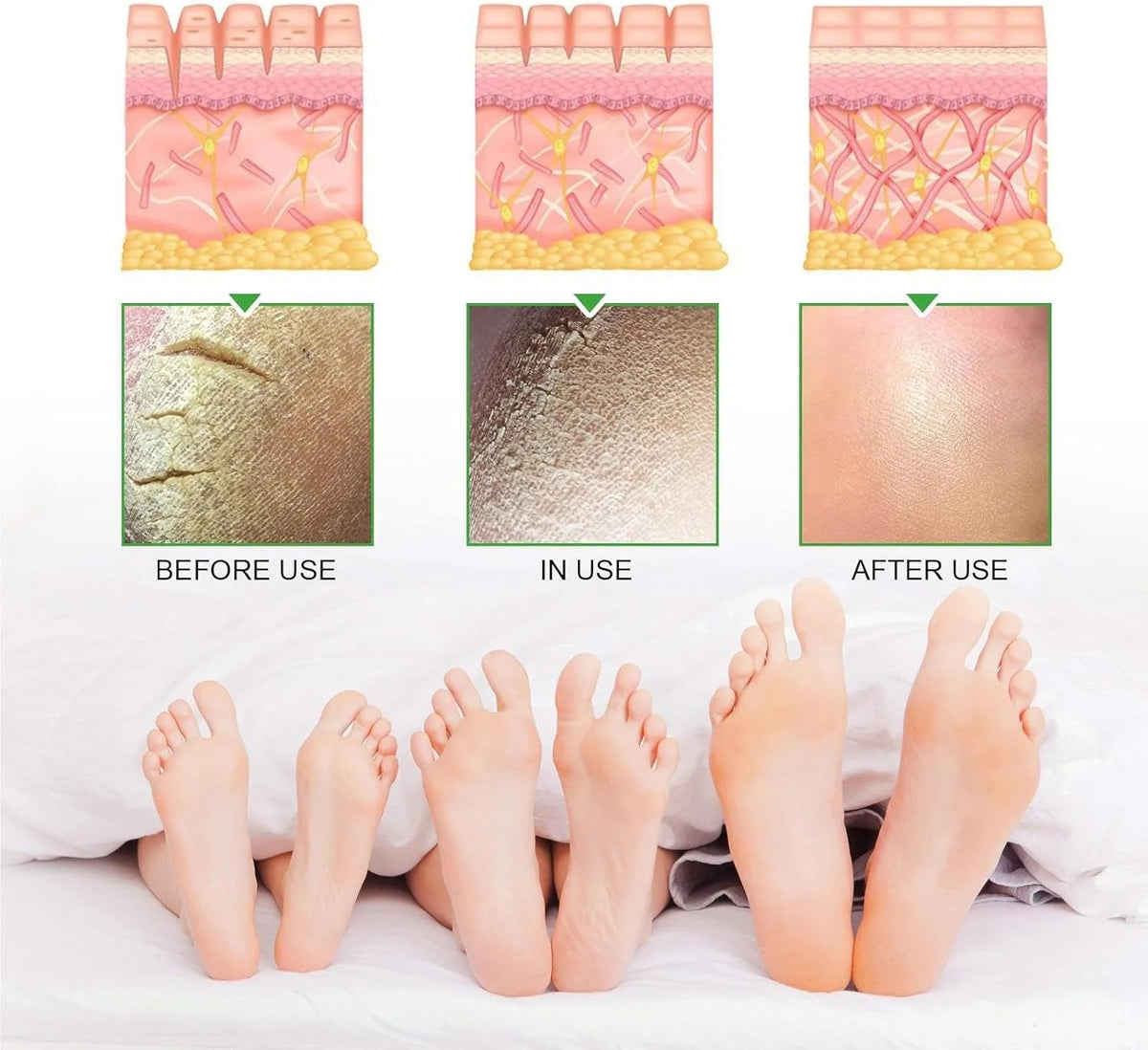 South Moon - 42% Urea Cream + 2% Salicylic Acid